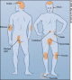 Pikkelys�m�r (Psoriasis)